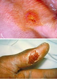 Types of Tularemia
