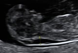 Maternal serum screening for chromosomal abnormalities