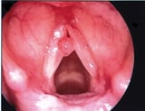 Differentiating Vocal Polyps, Nodules, and Granulomas