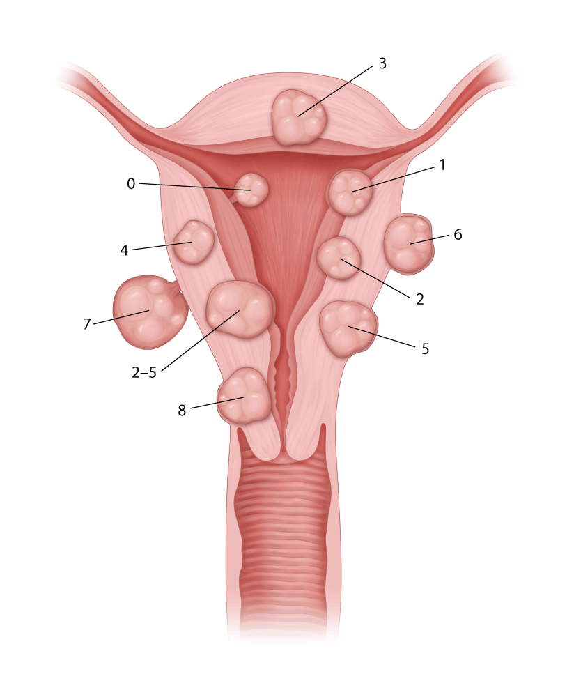 Figure 1 from Uterine Fibroids Associated with Infertility | Semantic  Scholar, image size:824x1000