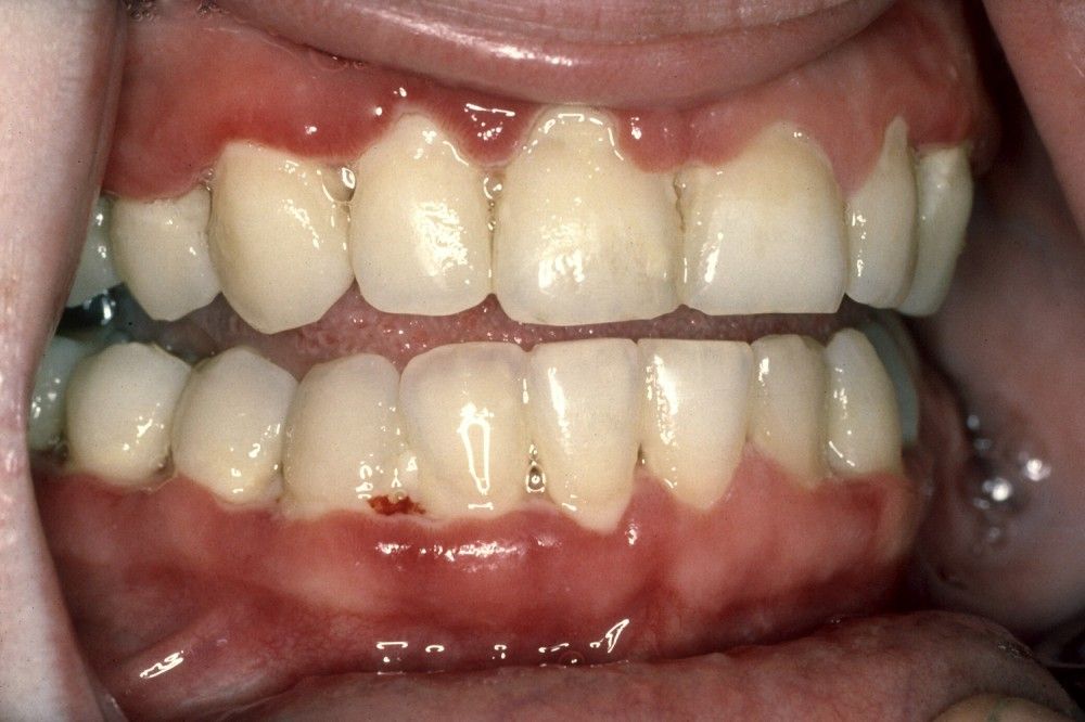 Acute Necrotizing Ulcerative Gingivitis (ANUG) - Mouth and Dental Disorders - Merck Manuals Consumer Version