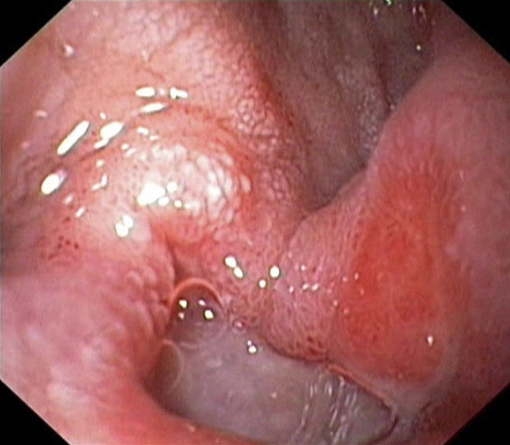 Peptic Ulcer Disease - Gastrointestinal Disorders - Merck Manuals Professional Edition