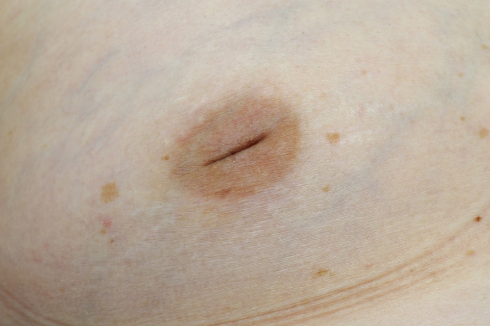 Lump nipple white on Inflammatory Breast