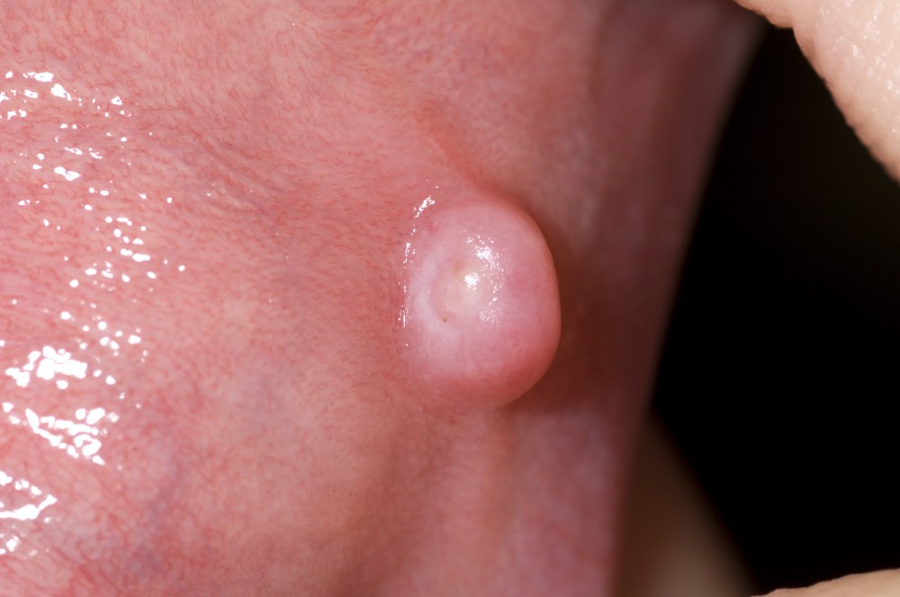 papilloma lump in mouth
