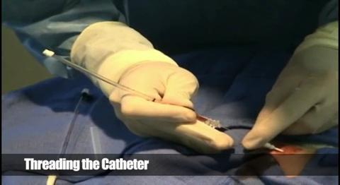 Введення артеріального катетера в променеву артерію