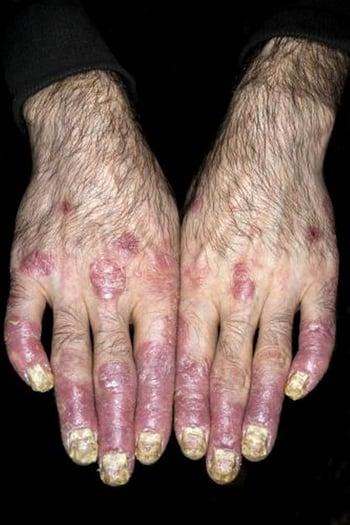 Псориатический артрит пальцев