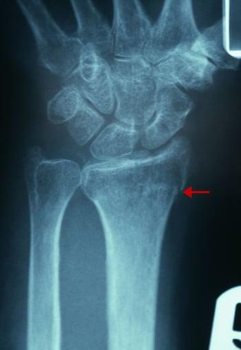 Приховані переломи дистального відділу променевої кістки