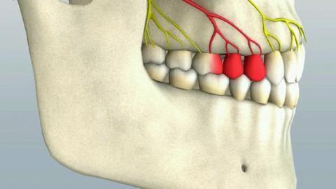 How To Do a Middle Superior Alveolar Nerve Block to Anesthetize Teeth
