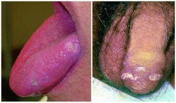 Úlceras bucales y genitales en la enfermedad de Behçet