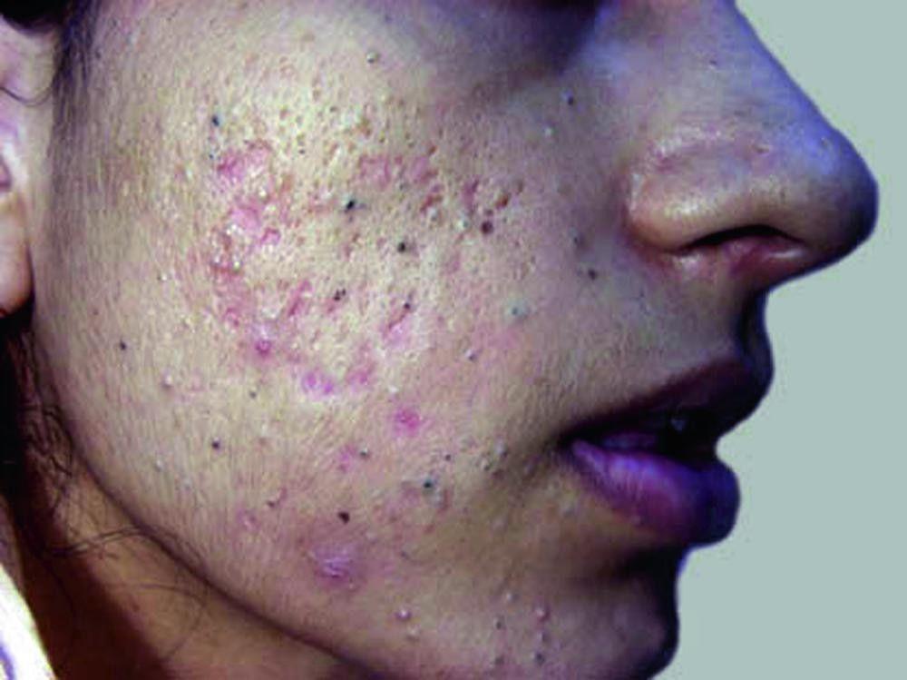 Acne With Large Blackheads and Whiteheads