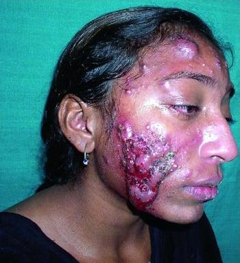 Acne Conglobata on the Face
