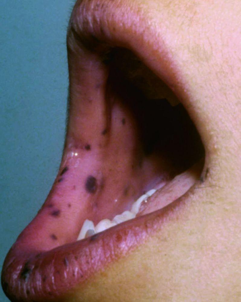 Taches bleu-noir à l’intérieur de la bouche et sur les lèvres (syndrome de Peutz-Jeghers)