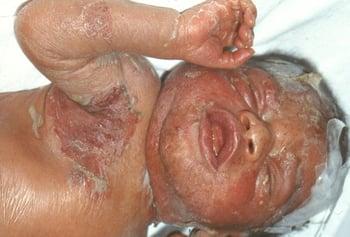 Syphilis chez le nouveau-né (éruption cutanée)