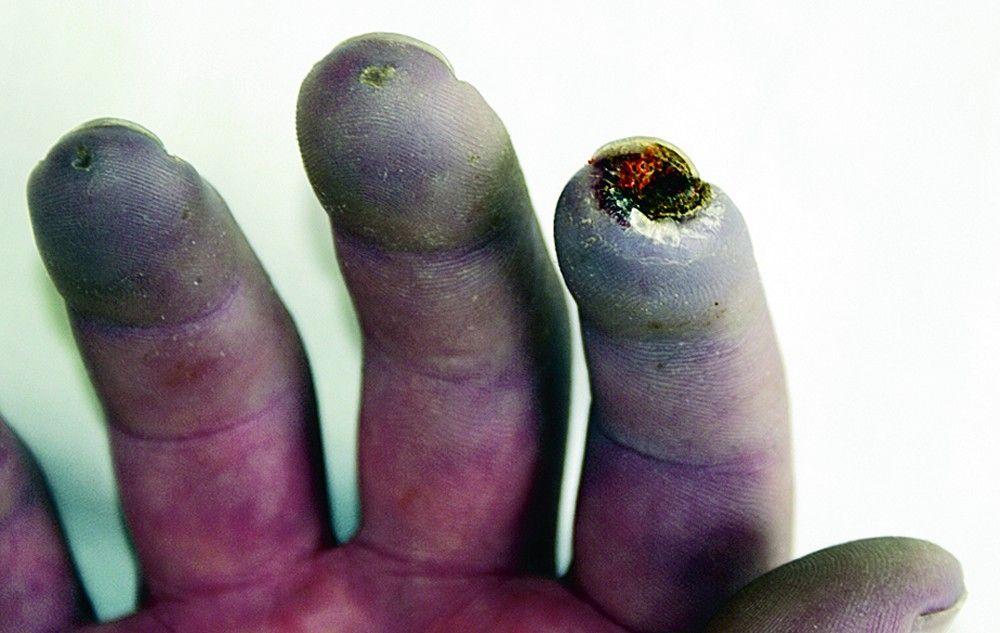 Raynaud Syndrome With Sores on Fingers