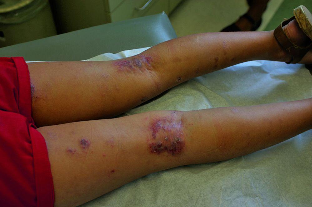 Dermatite atopique (arrière des genoux)