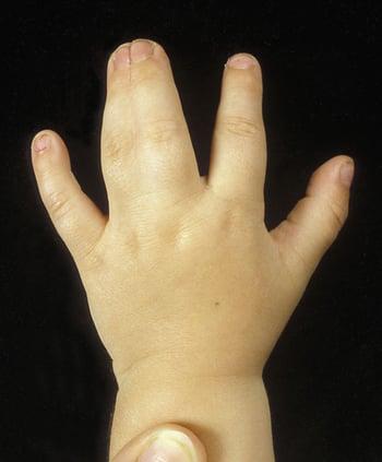 Syndactylie complexe de la main