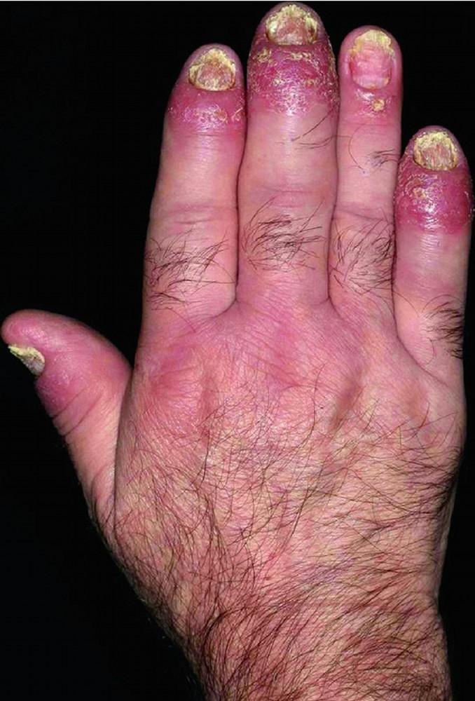 Psoriatic Arthritis (Dactylitis)