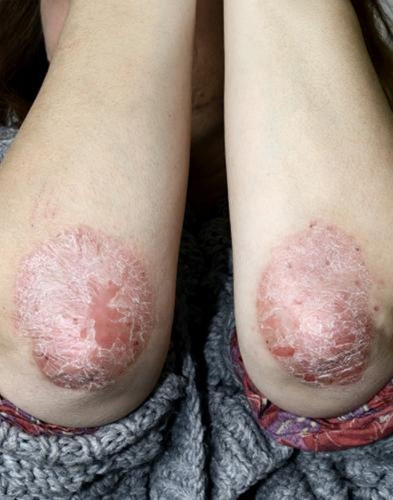 Psoriasis of the Elbows