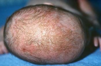 Cradle Cap (Seborrheic Dermatitis)