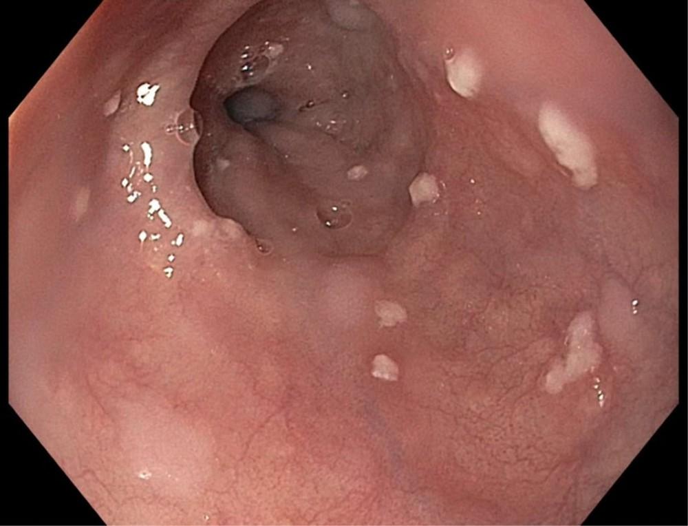 Candidiasis of the Esophagus