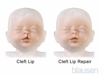 Cleft Lip Repair
