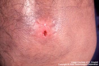 Coccidioidomicosis que causa una única úlcera