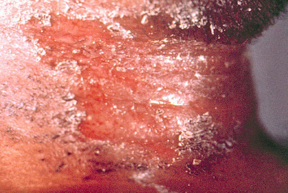 Difteria que afecta la piel