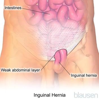 Hernia inguinal