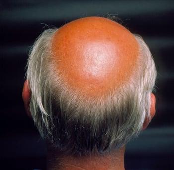 Alopecia androgénica