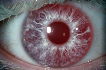 Albinisme (symptômes oculaires)