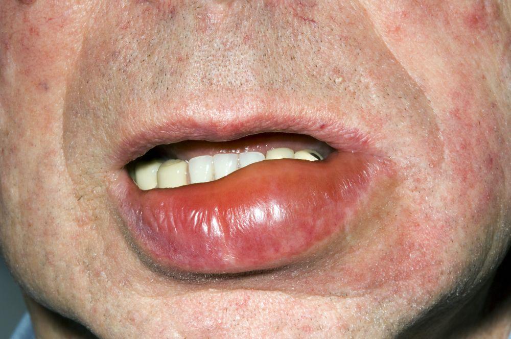 Angioedema de los labios
