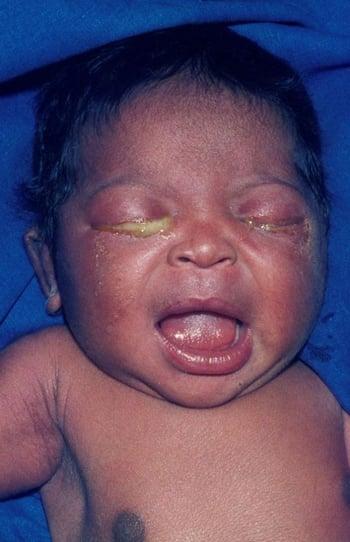 Conjuntivitis en un recién nacido