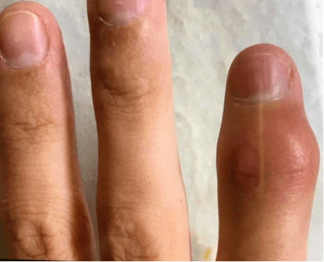 Swelling of a Distal Interphalangeal Joint