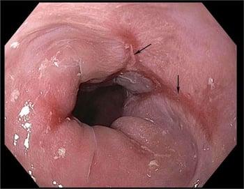 Œsophagite causée par un reflux gastro-œsophagien