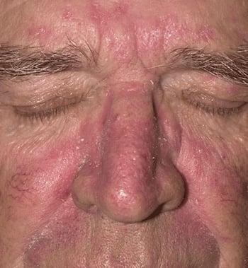 Dermatite séborrhéique (visage)