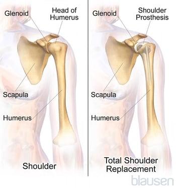 Total Shoulder Replacement (Arthroplasty)