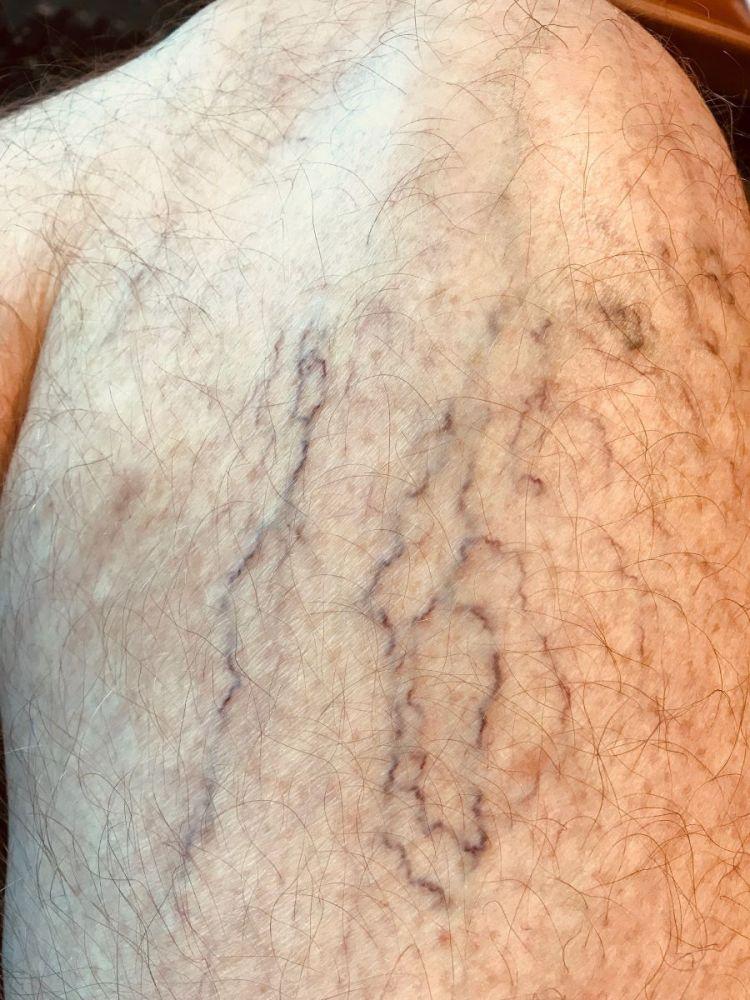 Arañas vasculares en la pierna