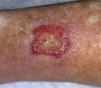 Dermatitis por estasis (úlcera)