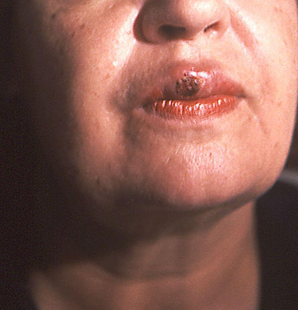 Sífilis primaria (chancro bucal)