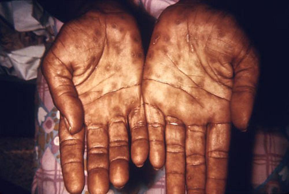 Syphilis – phase secondaire : éruption cutanée sur la paume des mains