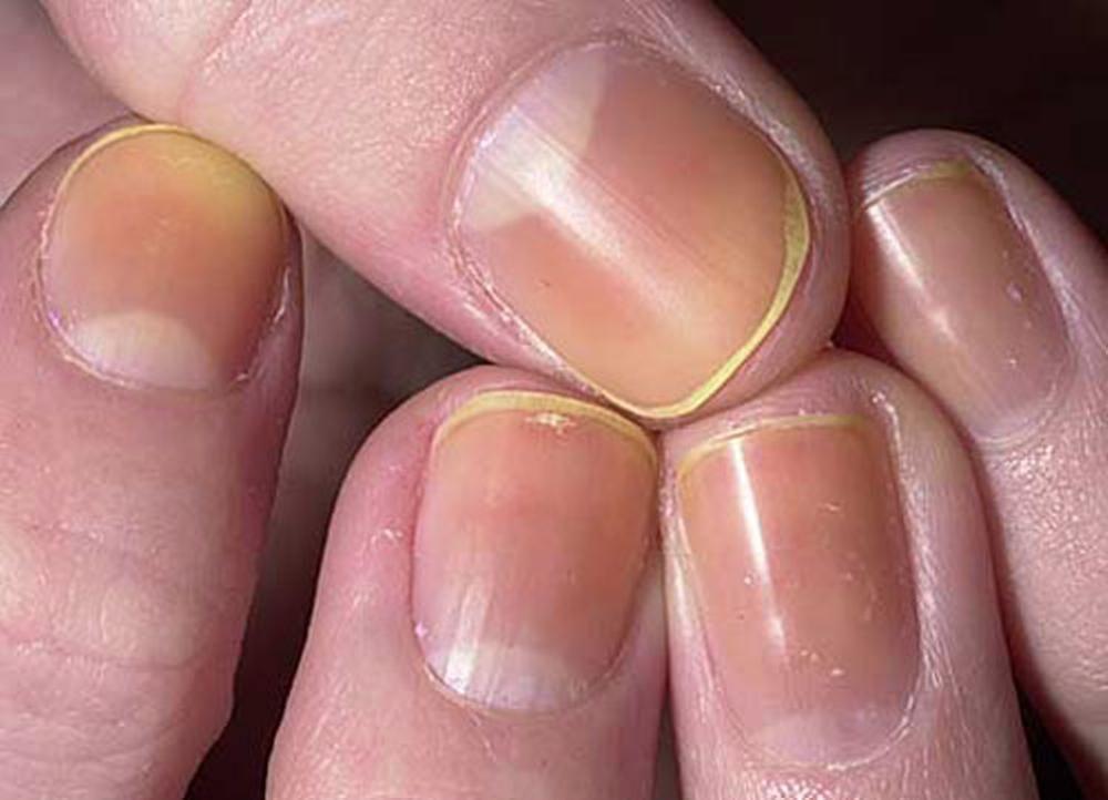 Changement de couleur des ongles dû à un vernis à ongles