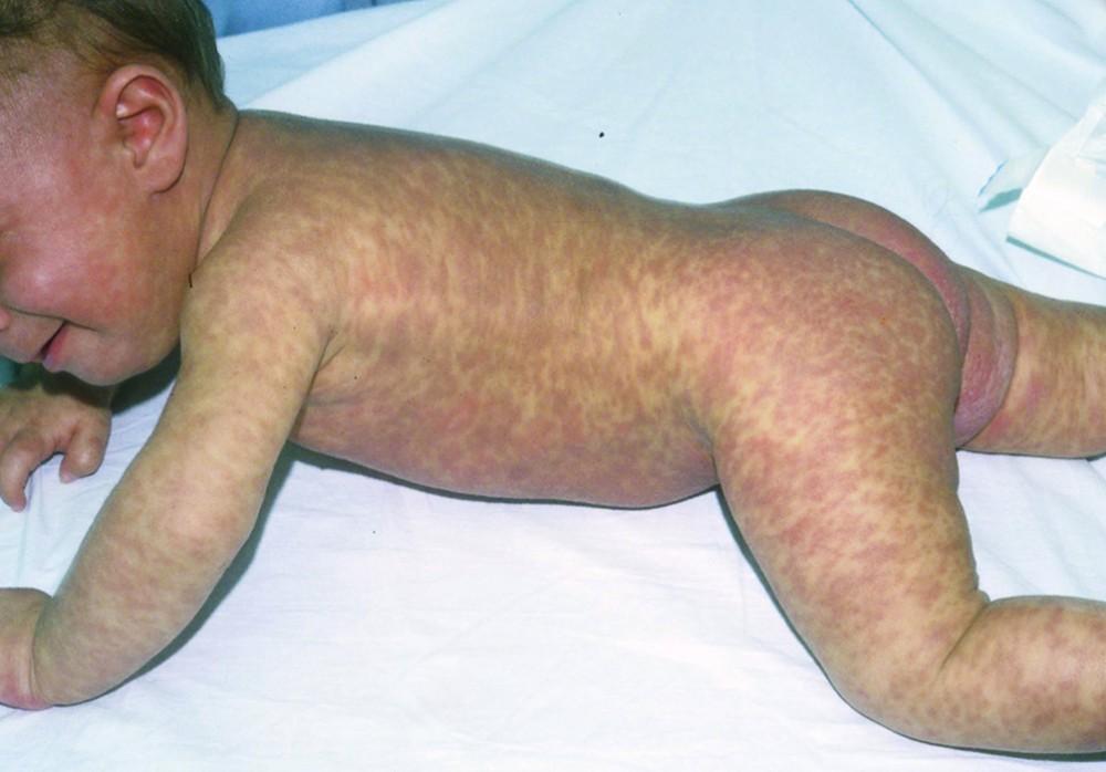 Urticaria Pigmentosa (Infant)