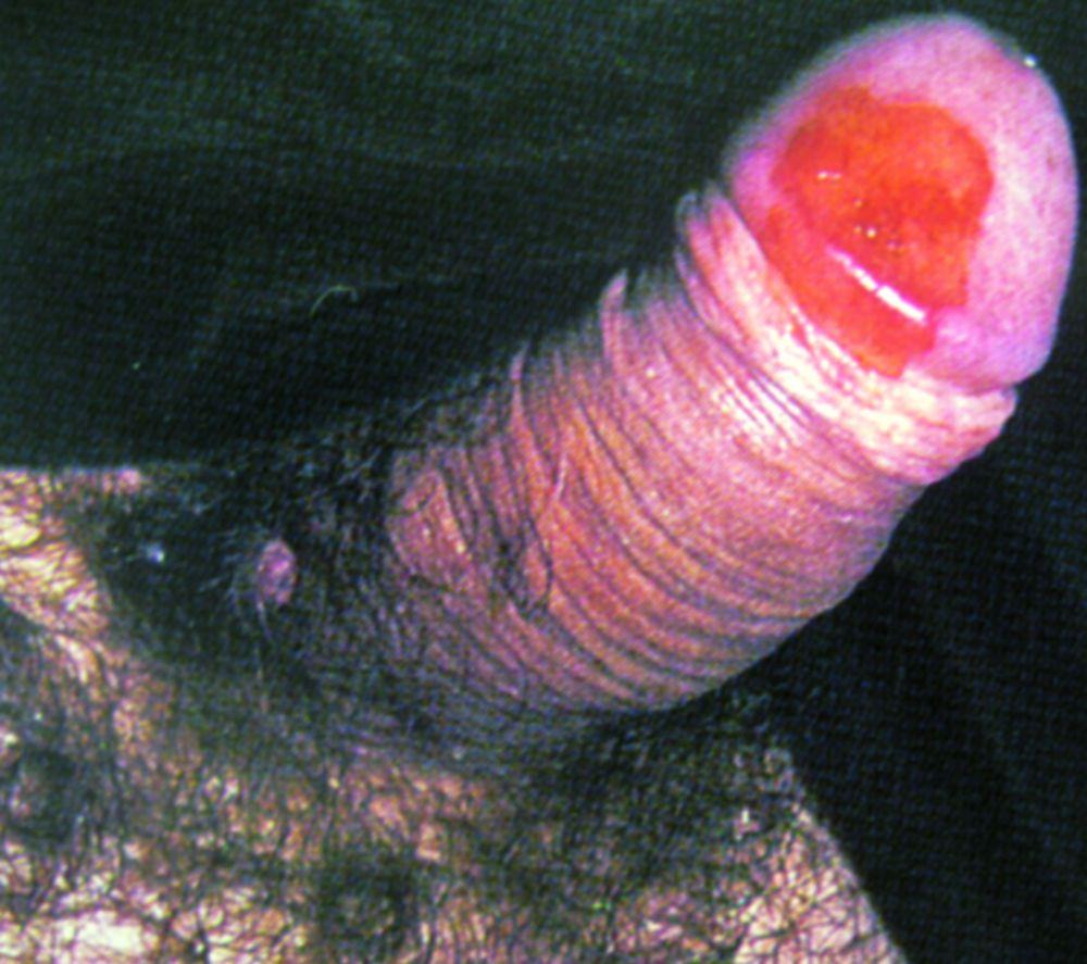 Érythroplasie de Queyrat avec carcinome in situ