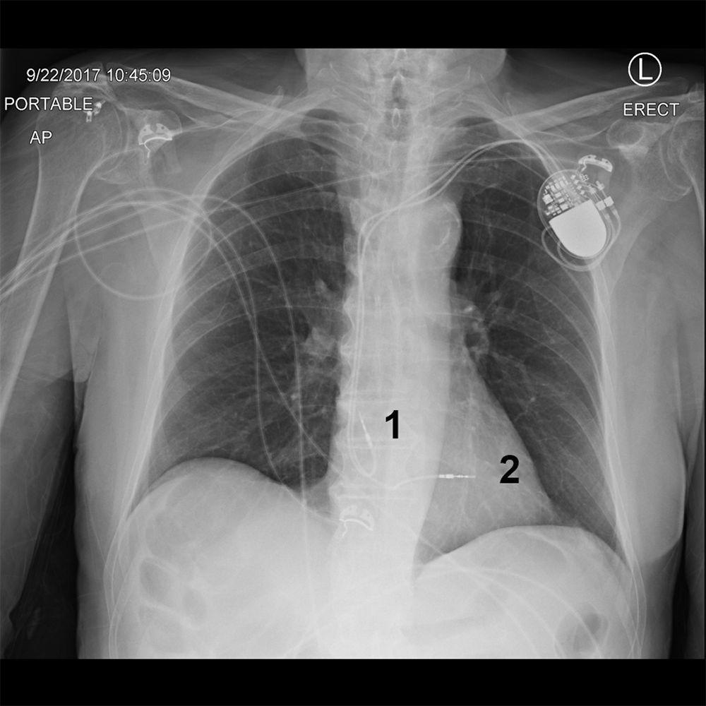 Radiographie pulmonaire d'un patient porteur d'un stimulateur cardiaque