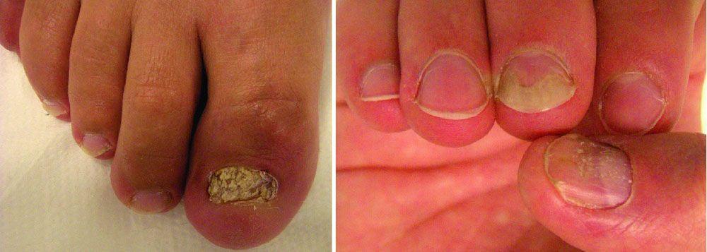 Psoriasis de las uñas con engrosamiento y desintegración de la lámina ungueal