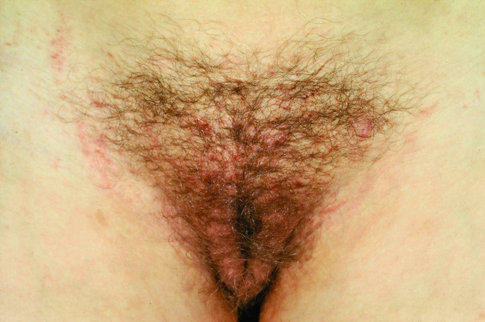 Pediculosis Pubis (Pubic Lice) With Excoriations