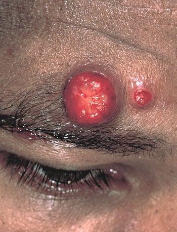 Angiomatose bacillaire (chez un patient infecté par le VIH)