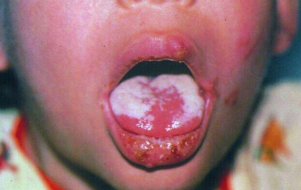 Oral Candidiasis Due to HIV
