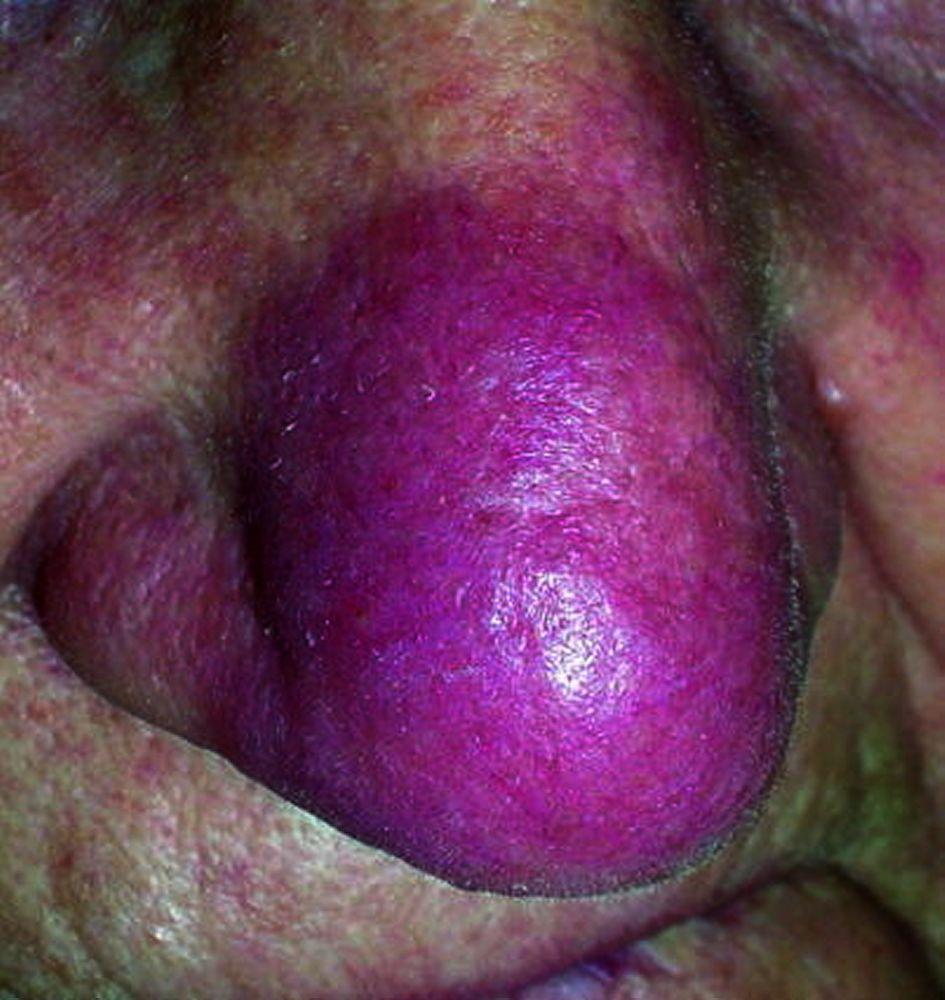 Sarcoïdose (Lupus pernio)