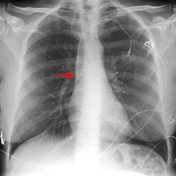 X-Ray of a Central Venous Catheter
